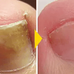 Pack 2x1 ReliefOil® | Aceite Natural para  para Cutículas Infectadas y Uñas Dañadas - Fortalece Uñas + Hidrata Cutículas + ENVÍO GRATIS