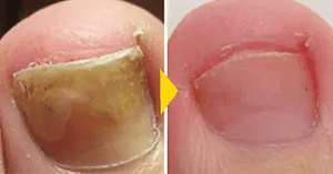 Pack 2x1 ReliefOil® | Aceite Natural para  para Cutículas Infectadas y Uñas Dañadas - Fortalece Uñas + Hidrata Cutículas + ENVÍO GRATIS