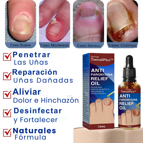 Pack 2x1 ReliefOil® | Aceite Natural para  para Cutículas Infectadas y Uñas Dañadas - Fortalece Uñas + Hidrata Cutículas + ENVÍO GRATIS